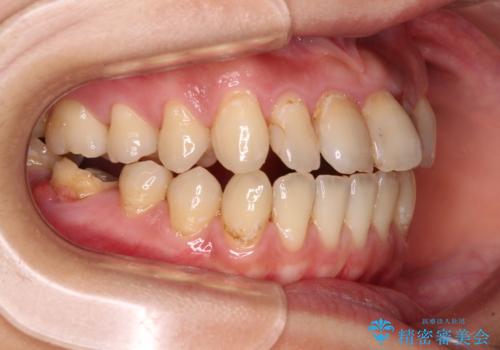 【モニター】開咬を治したい インビザラインによる矯正治療の治療前
