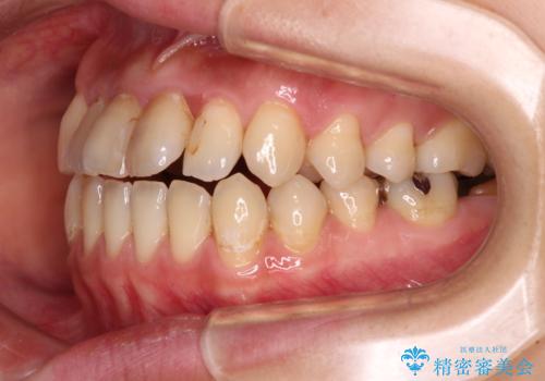 【モニター】開咬を治したい インビザラインによる矯正治療の治療前