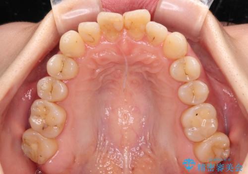 【モニター】開咬を治したい インビザラインによる矯正治療の治療前