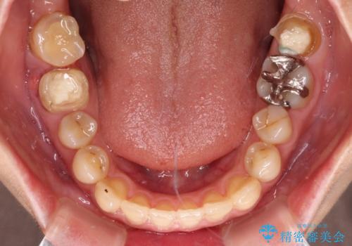 【モニター】開咬を治したい インビザラインによる矯正治療の治療前