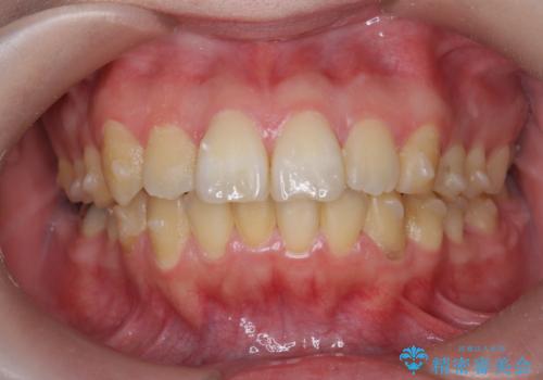 歯を抜かずに行う前歯の角度の改善の治療中