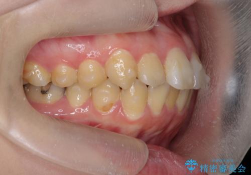 歯を抜かずに行う前歯の角度の改善の治療中