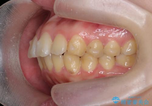 歯を抜かずに行う前歯の角度の改善の治療中