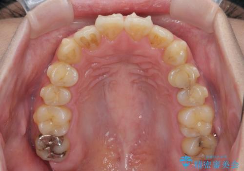 歯を抜かずに行う前歯の角度の改善の治療中