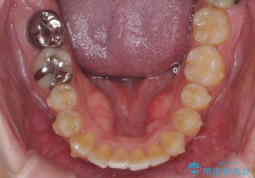 歯を抜かずに行う前歯の角度の改善の治療中