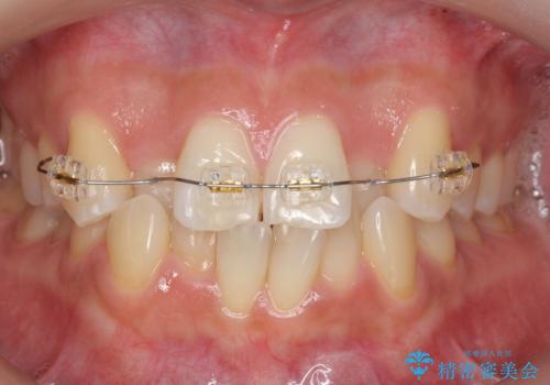 前歯のがたつき、中に入ってしまっている 部分矯正で低予算での治療中