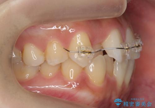 前歯のがたつき、中に入ってしまっている 部分矯正で低予算での治療中