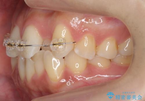 前歯のがたつき、中に入ってしまっている 部分矯正で低予算での治療中