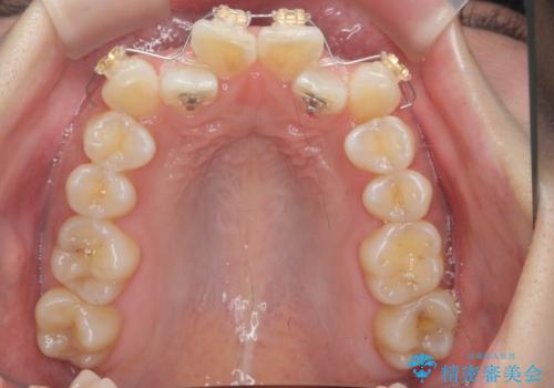 前歯のがたつき、中に入ってしまっている 部分矯正で低予算での治療中