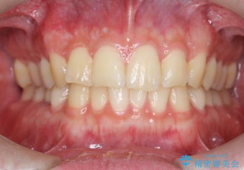 前歯のがたつきをなおしたい マウスピース矯正の症例 治療前