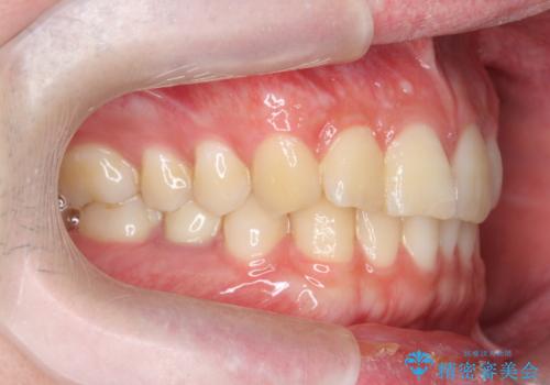 前歯のがたつきをなおしたい マウスピース矯正の治療前