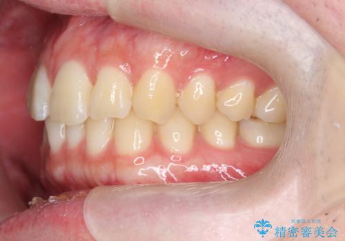 前歯のがたつきをなおしたい マウスピース矯正の治療前