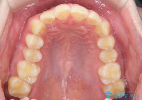 前歯のがたつきをなおしたい マウスピース矯正の治療前