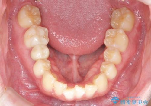 前歯のがたつきをなおしたい マウスピース矯正の治療前