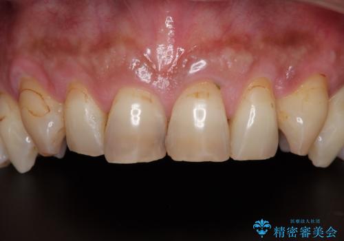 黄ばんだ前歯をきれいに　前歯の審美歯科治療の治療前