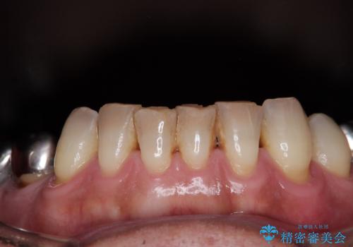 黄ばんだ前歯をきれいに　前歯の審美歯科治療の治療前