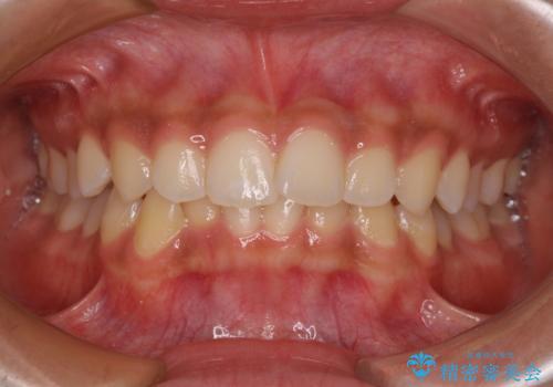 前歯のデコボコを治したい インビザライン・モデレートによる矯正治療の症例 治療前