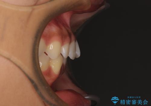 前歯のデコボコを治したい インビザライン・モデレートによる矯正治療の治療前