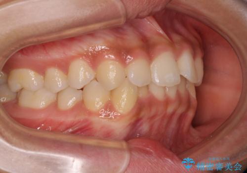 前歯のデコボコを治したい　インビザライン・モデレートによる矯正治療の治療前