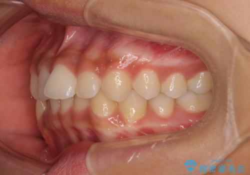 前歯のデコボコを治したい インビザライン・モデレートによる矯正治療の治療前