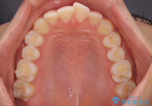 前歯のデコボコを治したい インビザライン・モデレートによる矯正治療の治療前