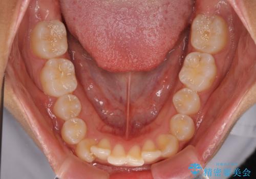 前歯のデコボコを治したい インビザライン・モデレートによる矯正治療の治療前