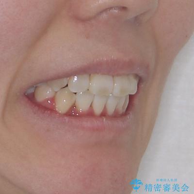 唇からはみ出るほど飛び出した前歯 ワイヤー装置による抜歯矯正の治療後(顔貌)