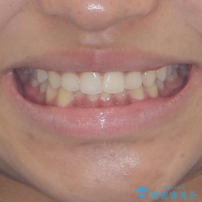 前歯のデコボコを治したい インビザライン・モデレートによる矯正治療の治療前(顔貌)