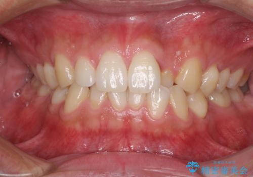 前歯のデコボコとクロスバイト　インビザライン矯正治療の症例 治療前