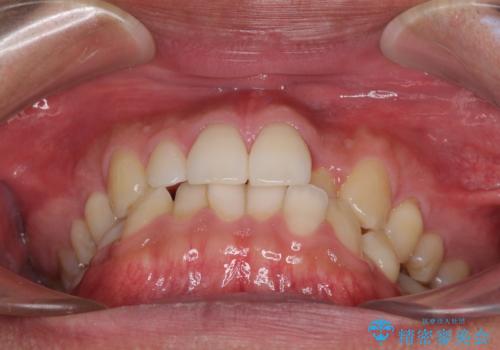 前歯のデコボコとクロスバイト　インビザライン矯正治療の治療前