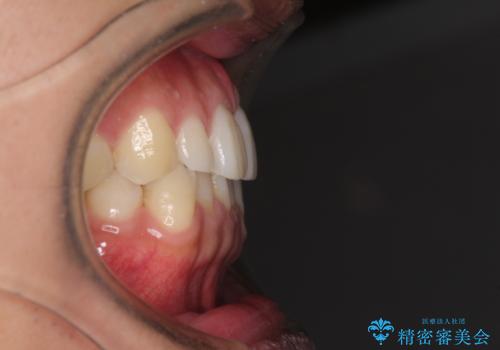 前歯のデコボコとクロスバイト　インビザライン矯正治療の治療前