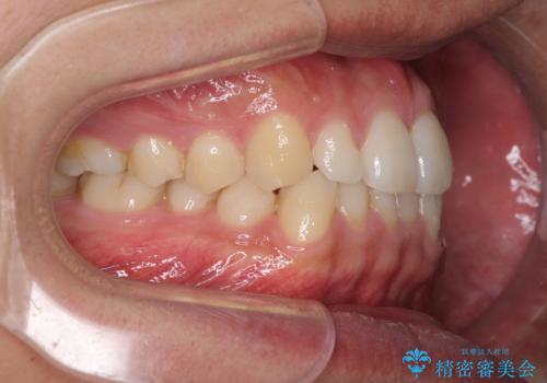 前歯のデコボコとクロスバイト インビザライン矯正治療の治療前