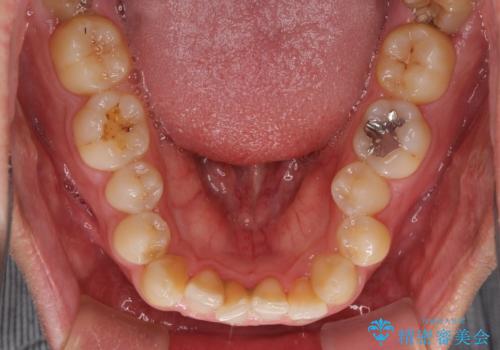 前歯のデコボコとクロスバイト インビザライン矯正治療の治療前