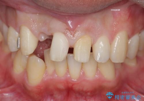 前歯をやむなく抜歯 ブリッジに 治療ついでに歯並びもよくの治療中