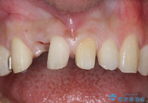 前歯をやむなく抜歯　ブリッジに　治療ついでに歯並びもよくの治療中