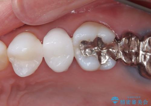 目立つ銀歯と露出した歯根　セラミックでの審美歯科治療