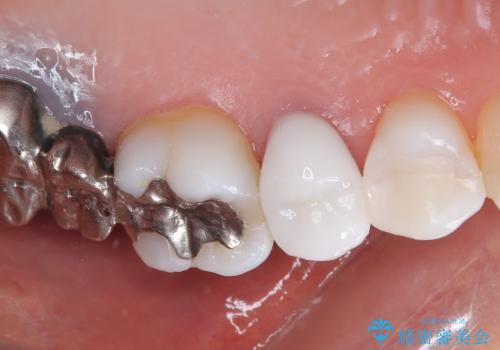 目立つ銀歯と露出した歯根 セラミックでの審美歯科治療の治療後