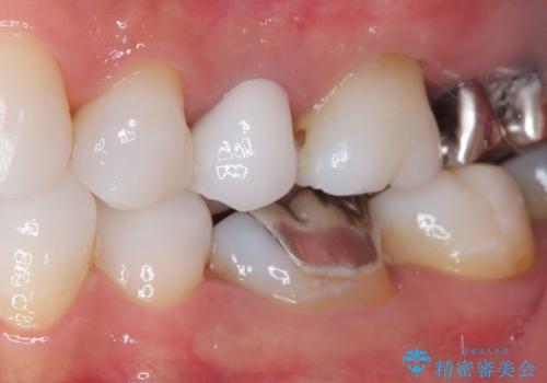 目立つ銀歯と露出した歯根　セラミックでの審美歯科治療の治療後