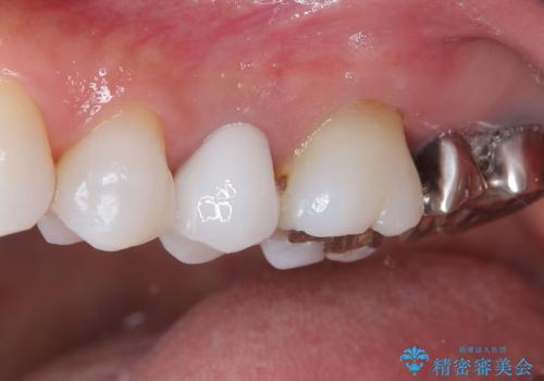 目立つ銀歯と露出した歯根　セラミックでの審美歯科治療の治療後