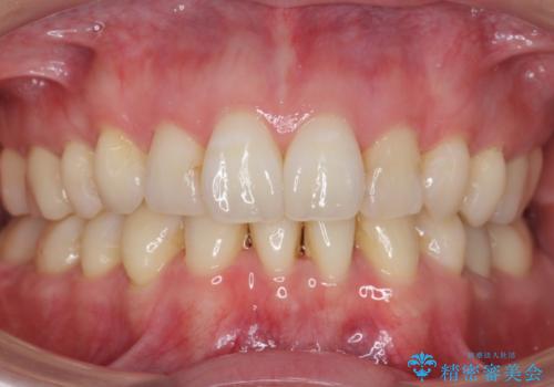 他院で3年以上かかると言われた八重歯を半年できれいに の症例 治療後