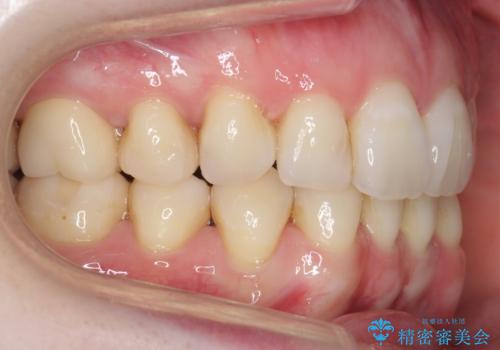 他院で3年以上かかると言われた八重歯を半年できれいに の治療後