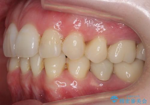 他院で3年以上かかると言われた八重歯を半年できれいに の治療後
