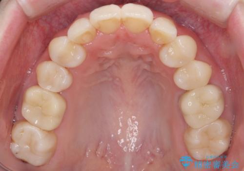 他院で3年以上かかると言われた八重歯を半年できれいに の治療後