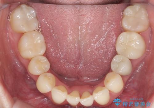 他院で3年以上かかると言われた八重歯を半年できれいに の治療後