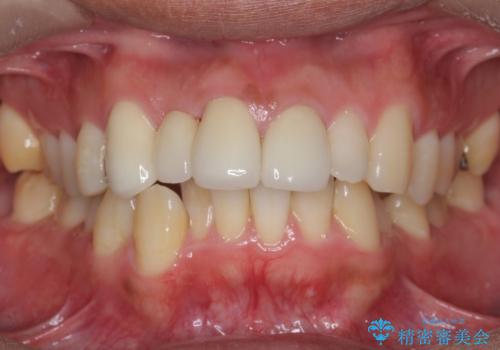 前歯をやむなく抜歯 ブリッジに 治療ついでに歯並びもよくの治療後