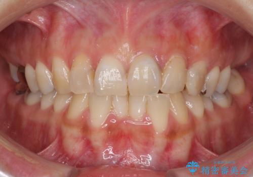 大きなむし歯と欠損をセラミックに　部分矯正を併用した総合歯科治療の症例 治療前