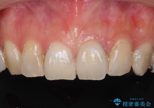 大きなむし歯と欠損をセラミックに 部分矯正を併用した総合歯科治療の治療前