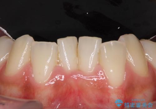 大きなむし歯と欠損をセラミックに 部分矯正を併用した総合歯科治療の治療前