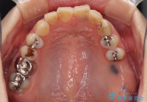 大きなむし歯と欠損をセラミックに 部分矯正を併用した総合歯科治療の治療前