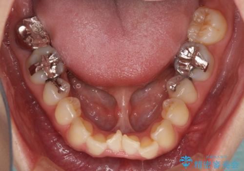 大きなむし歯と欠損をセラミックに 部分矯正を併用した総合歯科治療の治療前